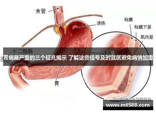 胃病最严重的三个征兆揭示 了解这些信号及时就医避免病情加重